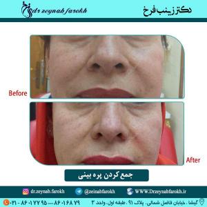 جمع کردن پره بینی