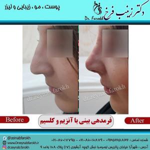 فرم-دهی-بینی-با-آنزیم-و-کلسیم-1