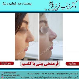 فرم-دهی-بینی-با-کلسیم-1