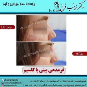 فرم دهی بینی با کلسیم