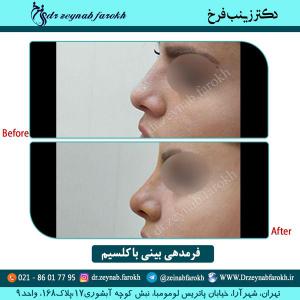 فرمدهی با کلسیم 9