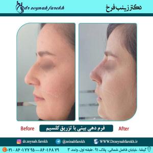 فرمدهی بینی با تزریق کلسیم 1