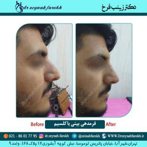 فرمدهی بینی با کلسیم