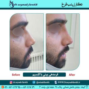 فرمدهی بینی با کلسیم 1