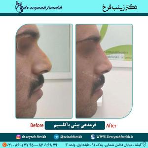 فرمدهی بینی با کلسیم 2