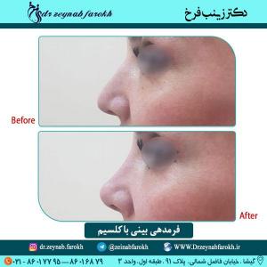 فرمدهی بینی با کلسیم 20