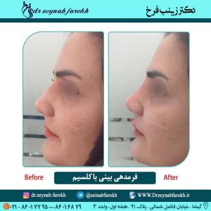 فرمدهی بینی با کلسیم 21