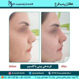فرمدهی بینی با کلسیم 22