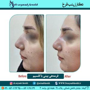 فرمدهی بینی با کلسیم 3