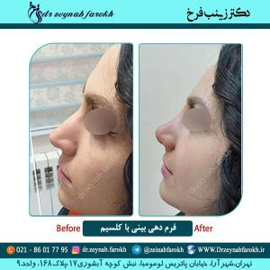 فرمدهی بینی با کلسیم 8