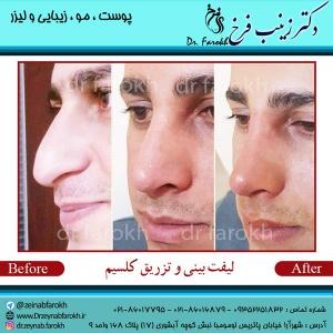 لیفت-بینی-و-تزریق-کلسیم