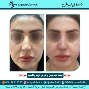 لیفت تیغه بینی 4