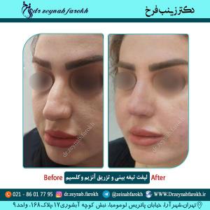 لیفت تیغه بینی 5