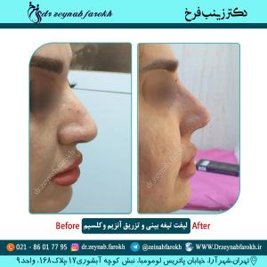 لیفت تیغه بینی 6