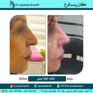 لیفت تیغه بینی در تهران 17