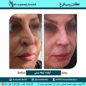 لیفت تیغه بینی در تهران 18