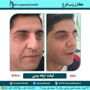 لیفت تیغه بینی در تهران 2