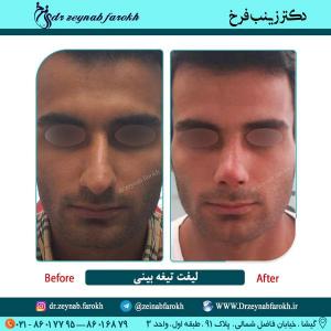 لیفت تیغه بینی در تهران 6