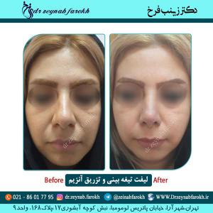 لیفت تیغه بینی و تزریق آنزیم