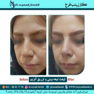 لیفت تیغه بینی و تزریق آنزیم 2