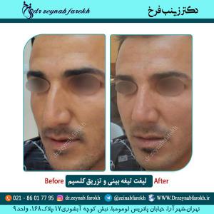 لیفت تیغه بینی و تزریق کلسیم 5