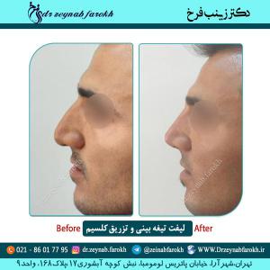 لیفت تیغه بینی و تزریق کلسیم 6
