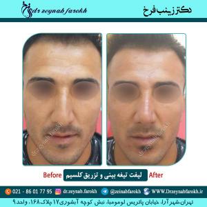 لیفت تیغه بینی و تزریق کلسیم 7