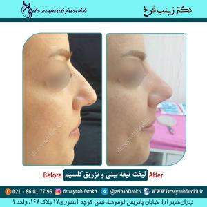 لیفت تیغه بینی و تزریق کلسیم 8