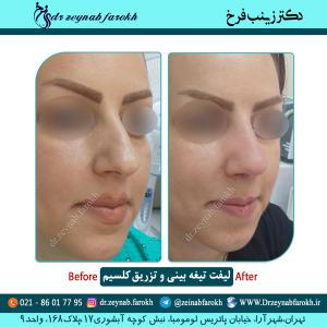 لیفت تیغه بینی و تزریق کلسیم 9
