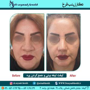 لیفت تیغه بینی و جمع کردن پره