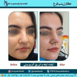لیفت تیغه و تزریق آنزیم بینی 280
