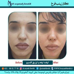 لیفت تیغه و تزریق کلسیم
