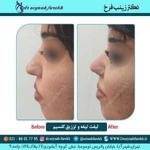 لیفت تیغه و تزریق کلسیم 2