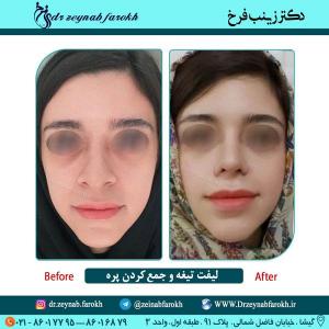 لیفت تیغه و جمع کردن پره 1