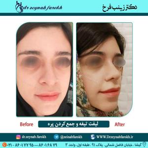 لیفت تیغه و جمع کردن پره 4