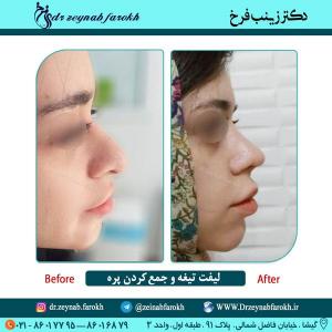 لیفت تیغه و جمع کردن پره 5