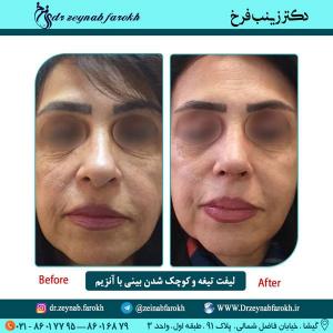 لیفت تیغه و کوچک شدن بینی با آنزیم 1