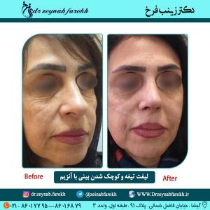 لیفت تیغه و کوچک شدن بینی با آنزیم 2
