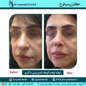 لیفت تیغه و کوچک شدن بینی باآنزیم