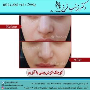 کوچک-کردن-بینی-با-آنزیم-2