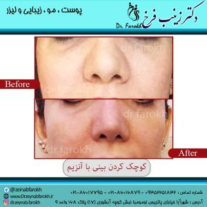 کوچک-کردن-بینی-با-آنزیم-3