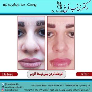 کوچک-کردن-بینی-با-آنزیم-4