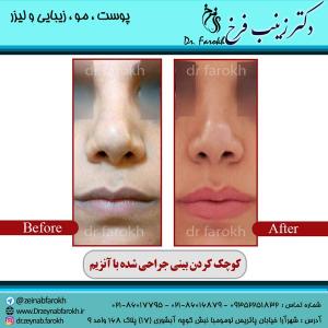 کوچک-کردن-بینی-با-آنزیم