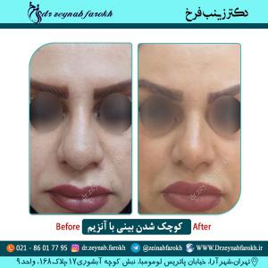 کوچک شدن بینی با آنزیم
