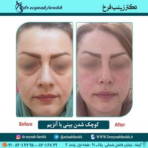 کوچک شدن بینی با آنزیم (1)