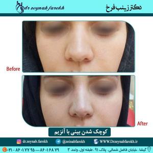 کوچک شدن بینی با آنزیم 1-3