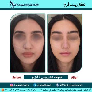 کوچک شدن بینی با آنزیم 1