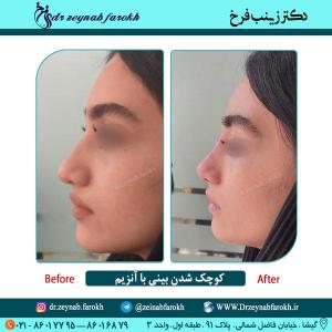کوچک شدن بینی با آنزیم 2