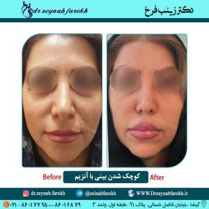 کوچک شدن بینی با آنزیم 20