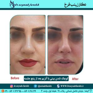 کوچک شدن بینی با آنزیم 21